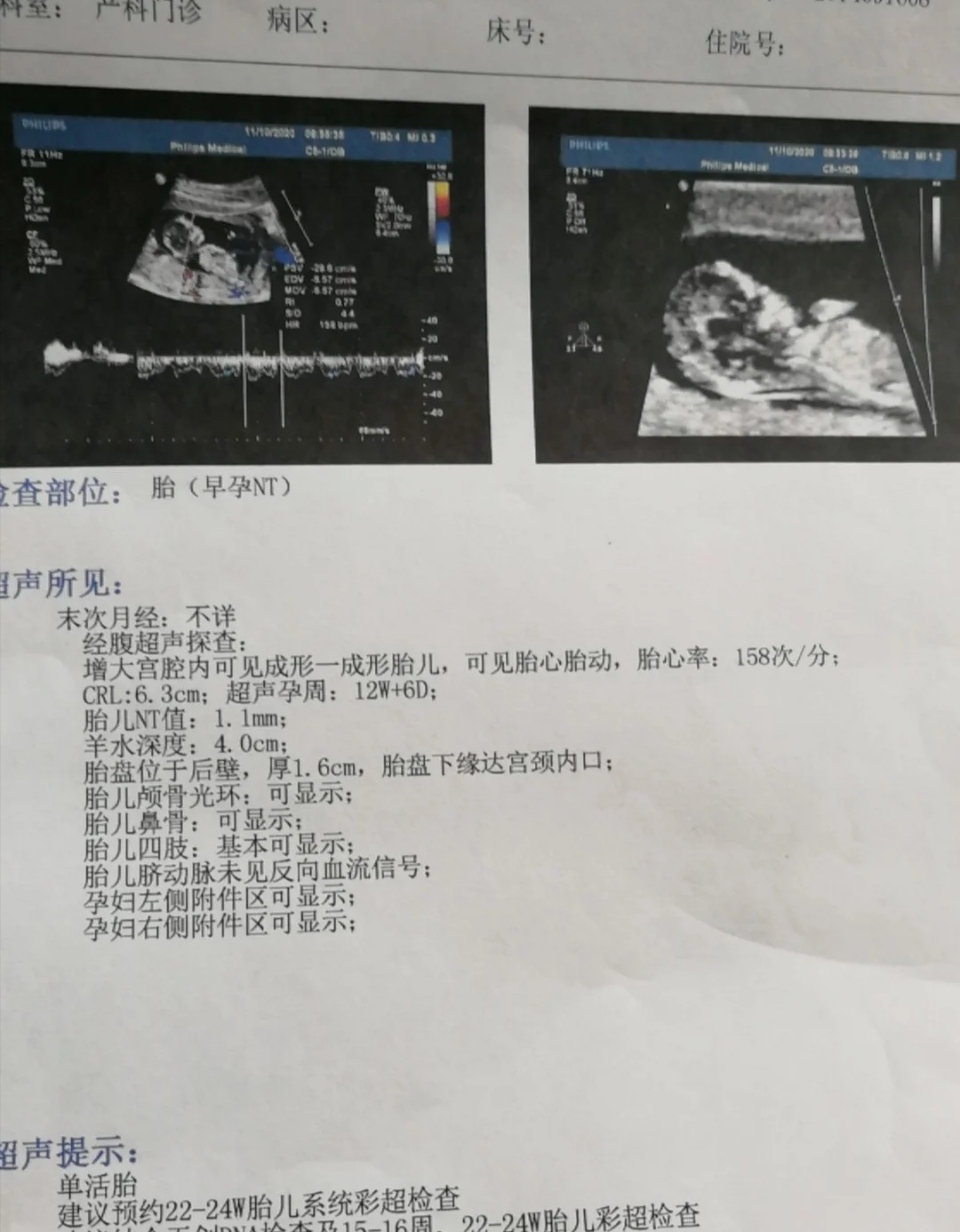 孕12周nt检查通过,医生说胎盘有点低